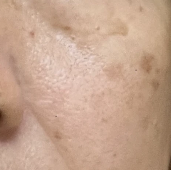 After：2週間使用後の頬。3つのシミが目立ちにくくなった状態（使用例）